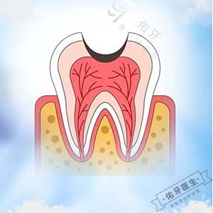 牙髓炎多久牙髓坏死