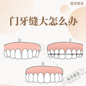 中间两颗门牙缝大怎么办?