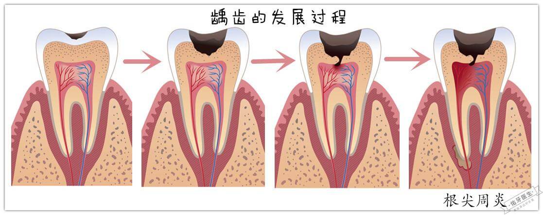 根尖周炎的症状与治疗方法解析 - 佑牙医生